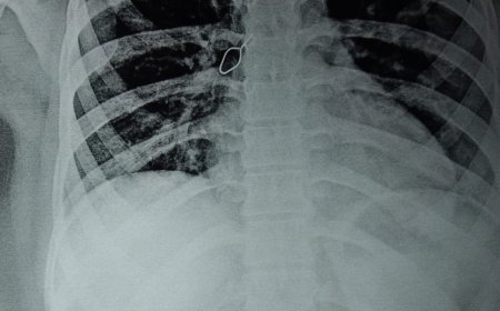 મહિલાના મોંમાંથી મોબાઈલ સિમ કાર્ડ કાઢવાની પિન ફેંફસામાં ફસાઈ ગઈઃ વાલાવલકર હોસ્પિટલની મેડિકલ ટીમ પીન દૂર કરવામાં સફળ રહી