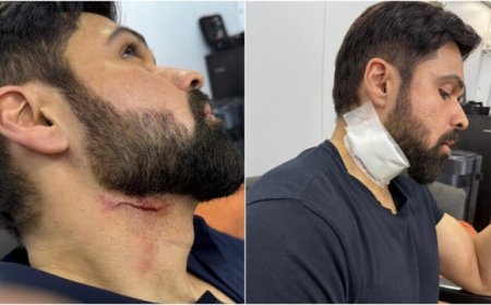 શૂટિંગ દરમ્યાન ઇમરાન હાશમી ઘાયલ થયા, ફોટા વાયરલ