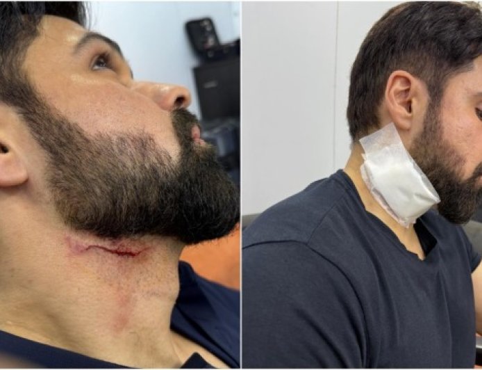 શૂટિંગ દરમ્યાન ઇમરાન હાશમી ઘાયલ થયા, ફોટા વાયરલ